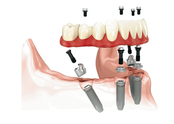 all on 4 dental implants los angeles ca